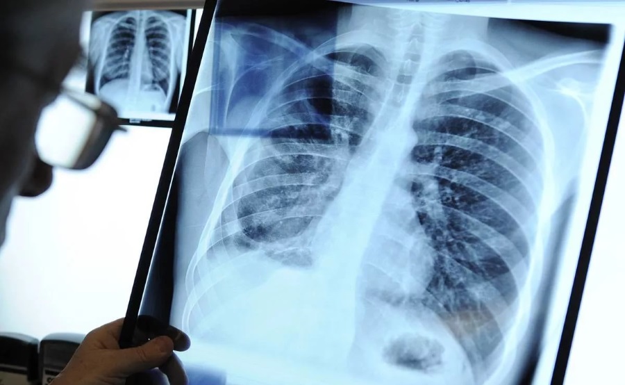 Девять местных жителей, больных активной формой туберкулеза, принудительно госпитализированы